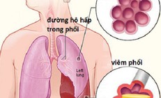 5 cách giúp chủ động phòng ngừa viêm phổi khi chuyển mùa
