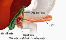 Sỏi túi mật khi nào cần mổ cấp cứu?