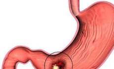Viêm loét dạ dày dễ tái phát vào dịp cuối năm