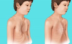 Thanh niên 18 tuổi mắc hội chứng Marfan biến chứng tim mạch nguy hiểm, bác sĩ cảnh báo dấu hiệu nhận biết sớm