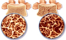 4 bí quyết giúp người lớn tuổi giảm nguy cơ loãng xương