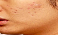 Sẹo rỗ có tự làm đầy được không?