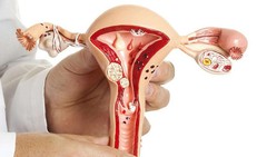 Vì sao nhân xơ tử cung khiến phụ nữ khó có thai?