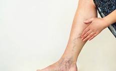 Yếu tố nguy cơ không nên xem nhẹ của suy tĩnh mạch chi dưới