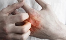 Bí quyết kiểm soát và phòng ngừa eczema hiệu quả