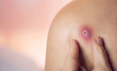 Thực phẩm giúp cải thiện tình trạng mụn nhọt trên da