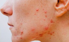 7 yếu tố dẫn đến tình trạng mụn viêm trên da