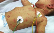 Bé gái 11 tuổi tử vong do viêm não mô cầu: Dấu hiệu nhận biết và cách phòng căn bệnh có nguy cơ tử vong trong 24 giờ