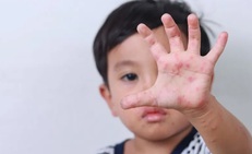 Vì sao bệnh tay chân miệng tăng mạnh ở trẻ mầm non vào đầu tuần?