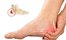 Biểu hiện điển hình khi mắc gai gót chân, đừng chủ quan với những cơn đau ở bàn chân