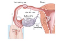 Hiếm gặp: Vừa có thai trong tử cung vừa có thai ngoài tử cung