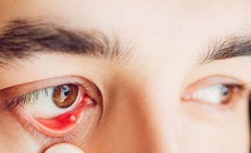 Nguyên nhân gây cộm mắt và cách khắc phục