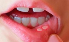Phân biệt nhiệt miệng và ung thư lưỡi: Cách nhận biết sớm căn bệnh nguy hiểm