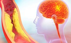 5 dấu hiệu cảnh báo thiếu máu não do hẹp động mạch cảnh