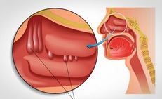 Nghẹt mũi, khó thở là biểu hiện của bệnh gì?