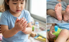 Tay chân miệng ở trẻ em: Những biến chứng cha mẹ không nên chủ quan