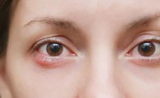 Ngứa rát, khô mắt kéo dài, cảnh giác với viêm bờ mi