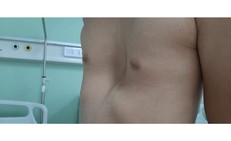 4 dấu hiệu phát hiện lõm ngực bẩm sinh ở trẻ