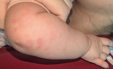 Bé gái 2 tháng tuổi mắc giang mai, nguy cơ nghiêm trọng nếu không được phát hiện