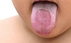 Những yếu tố làm tăng nguy cơ mắc lưỡi bản đồ