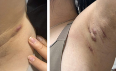 Viêm tuyến mồ hôi mủ dễ nhầm với mụn nhọt, áp xe