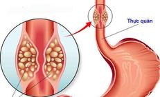 Triệu chứng hẹp thực quản: Đừng chủ quan khi thường xuyên nuốt nghẹn
