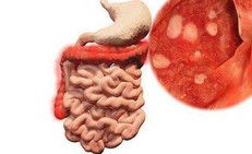Viêm ruột có nguy hiểm không?