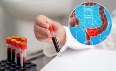 Ung thư đại trực tràng có chữa được không?