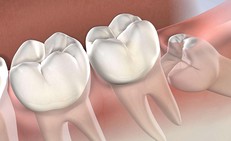 Răng số 8 mọc lệch có thể gây biến chứng gì?