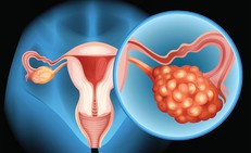 Chảy máu âm đạo bất thường, cảnh giác với ung thư buồng trứng