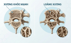 Nguy cơ gây loãng xương: Trường hợp nào cần chủ động đánh giá sức khỏe xương?