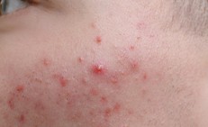 5 cách chăm sóc da và hạn chế trứng cá đỏ tái phát