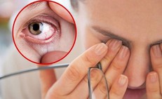 Chăm sóc người bị xuất huyết dưới kết mạc tại nhà