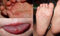 Trẻ đã từng mắc tay chân miệng vẫn có thể mắc lại