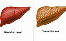 C&#226;n bằng chuyển h&#243;a – bảo vệ sức khỏe của gan