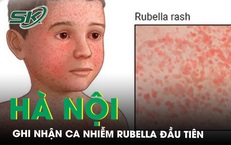 Ghi nhận ca mắc rubella đầu ti&#234;n tại H&#224; Nội trong năm 2024 