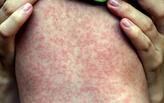 Xuất hiện ca mắc rubella đầu ti&#234;n trong năm 2024 tại H&#224; Nội