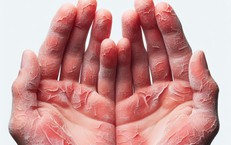 C&#226;u hỏi thường gặp li&#234;n quan đến bệnh vi&#234;m da cơ địa