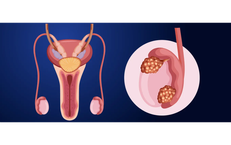 C&#226;u hỏi thường gặp li&#234;n quan đến ung thư tinh ho&#224;n