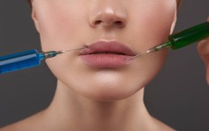 Những lưu &#253; trước v&#224; sau khi ti&#234;m filler m&#244;i