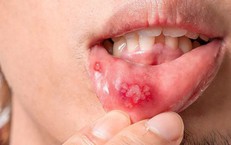 Vết thương hở v&#224; nguy cơ l&#226;y truyền HIV: Hiểu r&#245; để ph&#242;ng ngừa hiệu quả