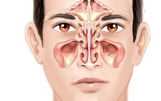 Bệnh vi&#234;m đa xoang c&#243; nguy hiểm kh&#244;ng?