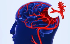Triệu chứng bệnh teo n&#227;o ở người gi&#224;