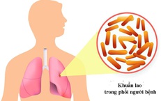 Hiểu về bệnh HIV tiến triển: Nguy cơ v&#224; c&#225;ch quản l&#253; hiệu quả