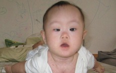 Trẻ mệt bất thường c&#243; thể mắc rối loạn nhược cơ bẩm sinh