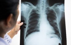 Bất ngờ ph&#225;t hiện ung thư phổi khi đi kh&#225;m sức khoẻ định kỳ