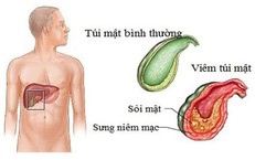 Dấu&#160;hiệu&#160;của&#160;vi&#234;m&#160;t&#250;i&#160;mật&#160;theo&#160;từng&#160;giai&#160;đoạn
