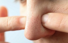 5 loại mặt nạ trị mụn đầu đen từ nguy&#234;n liệu nh&#224; bếp gi&#250;p da mịn sạch tự nhi&#234;n