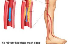 Bệnh động mạch chi dưới ở người cao tuổi dễ nặng l&#234;n v&#224;o m&#249;a lạnh