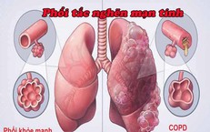 Nhận biết bệnh&#160;phổi&#160;tắc&#160;nghẽn&#160;mạn&#160;t&#237;nh